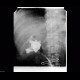 Biloma, leak from biliodigestive anastomosis: RF - Fluoroscopy